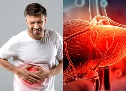 Men gan tăng cao có cần điều trị không?