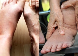 Phù chân khi nào đáng lo?