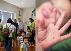 Tay chân miệng gia tăng, cha mẹ cần làm gì để bảo vệ trẻ khỏi nguồn lây?