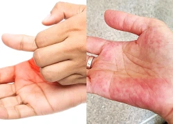 Ngứa lòng bàn tay, bàn chân kéo dài: Cẩn thận dấu hiệu liên quan đến bệnh gan