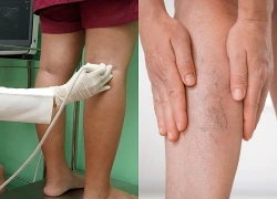 Tưởng mỏi chân do đứng bán hàng, đi khám phát hiện tĩnh mạch hiển suy nặng