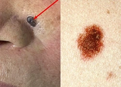 Biểu hiện ung thư da dễ nhầm lẫn với bệnh da liễu thông thường