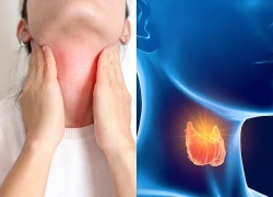 Người bệnh tuyến giáp nên ăn uống thế nào?
