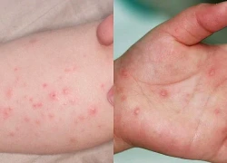 Tp.HCM ghi nhận số ca tay chân miệng tăng 47% trong một tuần