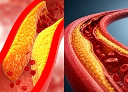 3 hiểu lầm phổ biến về mỡ máu